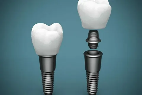 Understanding Dental Implants