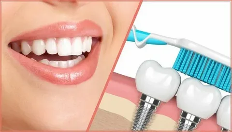 What to Expect with Dental Implants